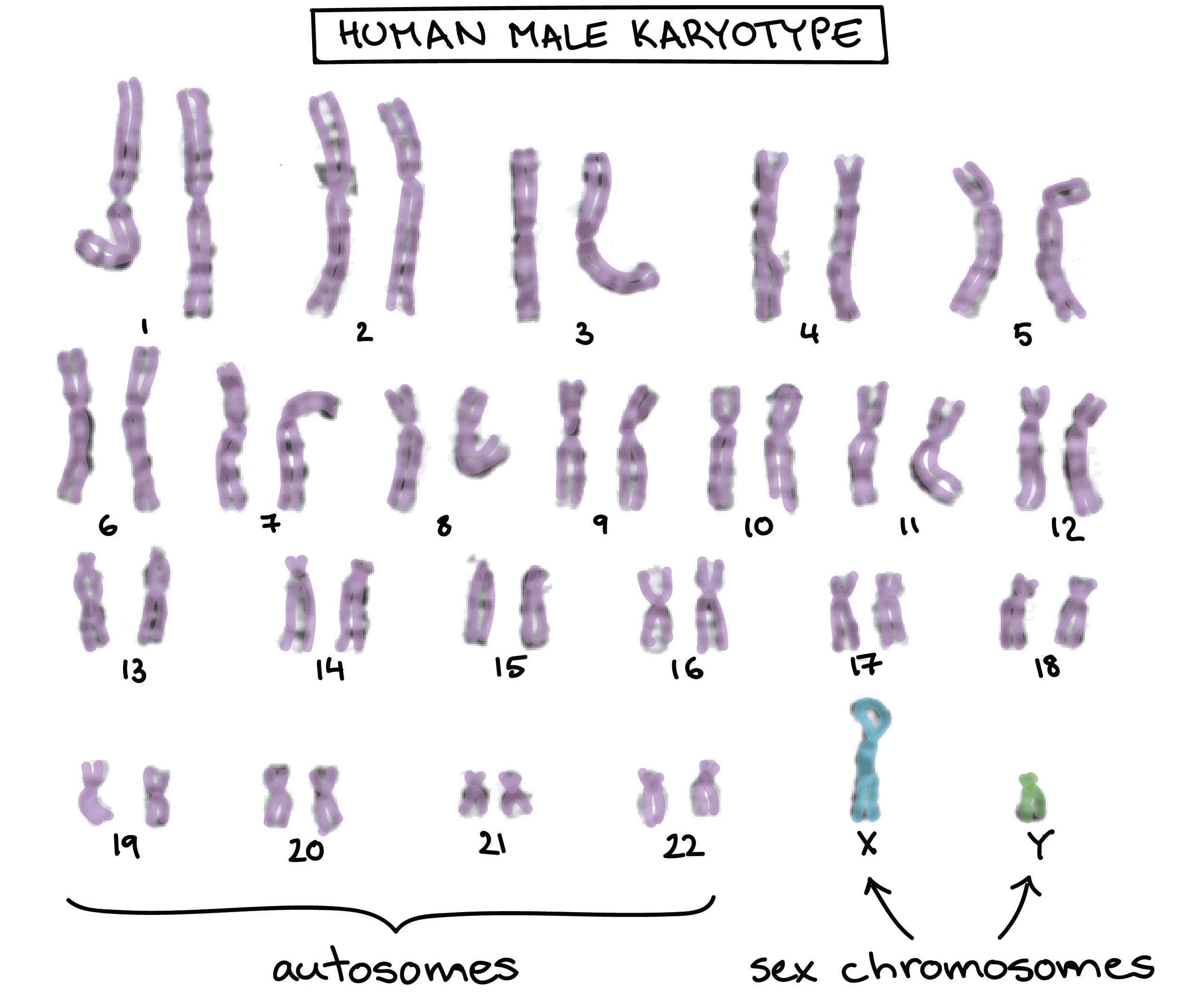 Hemophilia Karyotype Chart